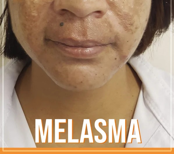 Melasma pode ser tratado com ativos específicos